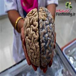 به دست گرفتن مغز واقعی انسان در موزه مغز هند
